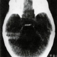 Figura 3. Tumor infiltrante hipodenso de tronco cereral.con desplazamiento dorsal del cuarto ventrículo.
