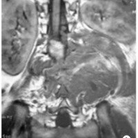 Fig. 2. Imágenes preoperatorias: IRM coronal (A).