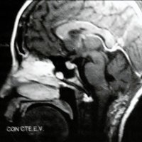 Fig 4. IRM postquirúrgica de cerebro. Control a los 6 meses. Libre de tumor
