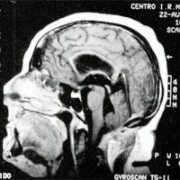 Fig. 2. IRM sagital postoperatoria, sin evidencia de lesión.
