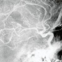 Figura 2. D post operatorio: el aneurisma clipado, sin constatarse vasoespasmo.