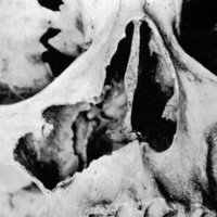 Figura 6. Cráneo seco: Resultado luego de la osteotomía de la apófisis frontal del Maxilar Superior.