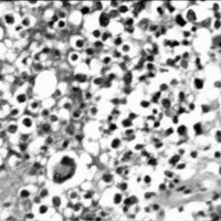 Fig. 2. Tumor medular. Alterne sectores de tipo oligodendroglioma.