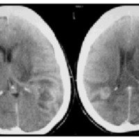 Fig. 5. TAC de cerebro posterior a tratamiento oncológico que muestra recidiva tumoral.
