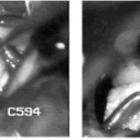 Fig. 1. Microcirugía descompresiva neurovascular: estructura vascular disecada, nótese indentación en el nervio trigémino (A), Ivalon separando el nervio del vaso (B).