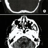Fig. 4. Paciente sexo masculino de 52 años de edad. Corte axial de tomografia computada. A. Ventana ósea. B. Ventana parenquimatosa a los 59 meses de postoperatorio mostrando reconstitución ósea izquierda.