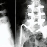 Fig. 4. Radiografía postoperatoria: se observan elposicionamiento de los tornillos transpediculares y las barras.