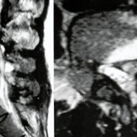Fig. 2. IRM con gadolinio: a los 2 meses post cirugia, observandose la recidiva de hernia discal con cambios inflamatorios perifericos.
