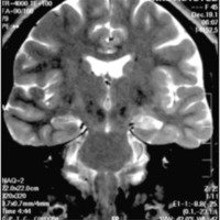 Fig. 5. IRM coronal, secuencia FSE ponderada en T2 que muestra atrofia e hiperseñal del hipocampo izquierdo.