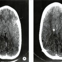 Fig. 2. TAC de paciente con síndrome de ventrículos colapsados.
