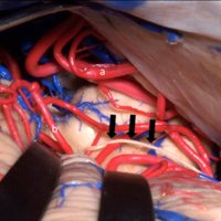 Figura 2: En este preparado anatómico puede observarse la exposición microquirúrgica, se demarca la exposición de la arteria cerebral posterior (a) y la arteria cerebelosa superior (b). Las flechas negras marcan el cuarto nervio.