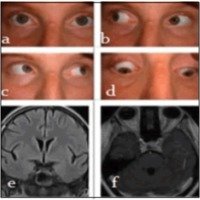 Fig. 2. a,b,,d. Recuperación total de la motilidad ocular del ojo izquierdo luego de tres meses de tratamiento con corticoides. e,f. IRM de encéfalo: control que evidencia la remisión completa de la lesión en el seno cavernoso izquierdo<br />
