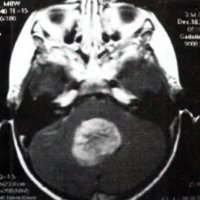 Metástasis Supratentorial de Meduloblastoma de Fosa Posterior 