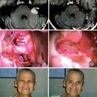 Fig. 4. Caso 3 del Cuadro 1. Paciente mujer de 72 años, con un tumor T3 b. A IRM preoperatoria. B. IRM postoperatoria. C. Imagen del ángulo pontocerebeloso, con la preservación del nervio facial, luego de la resección tumoral. D. Imagen del CAI, con la preservación del nervio facial, luego de la resección tumoral. E y F. Función facial postoperatoria.