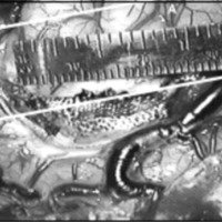 Fig.5. Vista intraoperatoria en una amígdalo-hipocampectomía izquierda utilizando los parámetros convencionales para la corticectomía. A-A´: línea frontorrolándica. B-B´: línea tempororrolándica.