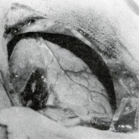 Figura 2: Cortícotomía transfrontal. Se observa el colapso cerebral. 