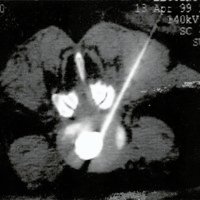 Fig. 4. Paciente GS. Inyección del contraste	