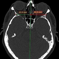 Referencias anatómicas óseas en tomografía computada para el abordaje transesfenoidal a la base de cráneo