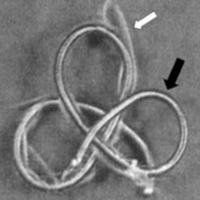 Fig. 2. Espiral miniaturizada ("microcoil") de platino calibre 0.018" modelo "Flower Coils Target MR" fabricados en 1988. Nótese estructura metálica (flecha negra) y pequeñas fibras de Dacron (flecha blanca) que aumentaban la trombogenicidad del implante.
