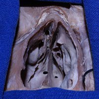 Figura 21: Preparado cadavérico que evidencia el rostrum esfenoidal y ambos ostium esfenoidales, tras realizada la sección del septum nasal.