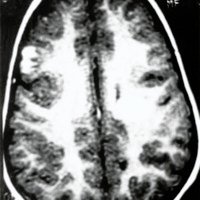 Fig. 2. IRM de ingreso, corte axial. Se observan 2 lesiones supratentoriales, una periférica (frontal derecha) y una profunda (cápsula interna y corona radiata), sin signos de edema perilesional ni efecto de masa,