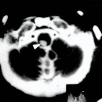 Fig. 2. Se observa en la tomomielografia computada una imagen de siringobulia (flecha)