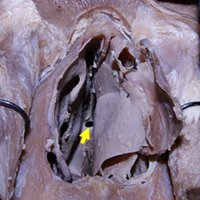 Figura 10: Preparado cadavérico que evidencia el canal de trabajo, previa turbinectomía media. Nótese la presencia del ostium esfenoidal (flecha).