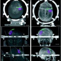 Fig. 4. Estudio tomográfico de cerebro, con marco de estereotaxia colocado. Procesamiento con MRIcro. A. Reconstrucción tridimensional de la cabeza del paciente. Se definieron en los cortes axiales 2 ROI, la lesión tumoral (violeta) y la sutura coronal derecha (verde), mostrando la relación estrecha entre ambas. B. Profundización de planos, llegando a visualizar el cráneo y sus suturas.