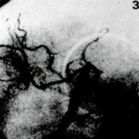 Figura 2. By-Pass Subclavio-Silviano, angiografía postoperatoria, vista de perfil. 
