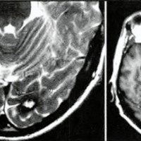 Fig. 2. IRM A: corte axial ponderado en T2 que muestra lesion de 12 x 7,4 mm a nivel occipital izquierdo. B: corte axial ponderado en T1, sin gadolinio, donde se observa el control postoperatorio sin evidencias de persistencia.<br />
