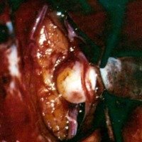 Foto intraoperatoria Nº 4. Se logra el control proximal de ambas pericallosas. Nótese como la arteria callosomarginal está adherida al fondo aneurismático.