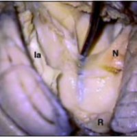 Fig. 13. Resecada la tela coroidea, el disector levanta el velo medular inferior a nivel del receso posterolateral. N: nódulo. U: úvula. R: banda acanalada de Reil, que se continúa hacia delante con el velo medular inferior. Es un puente de hemisferio cerebeloso atrófico entre úvula y amígdala, como el velo lo es entre nódulo y flóculo. Ia: inserción de la amígdala.