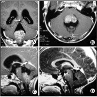 Fig. 5. Ependimoma del piso del IV ventrículo: A. Corte coronal; B. Corte axial que muestra la adherencia al piso del IV ventrículo; C. Corte sagital que muestra el tumor a través del orificio de Magendie; D. Control postoperatorio que muestra resección subtotal.