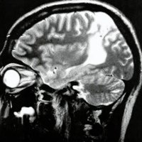 Fig. 5. Lesión por hipoxia neonatal. El área epileptogéníca primaria se ubicó en el lóbulo temporal !