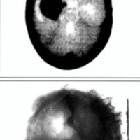 Fig. 1. Aneurisma gigante de carótida interna en un niño de 2 años de edad abordado por craniotomía pterional. A) TC: B) angiografia preoperatoria frente.