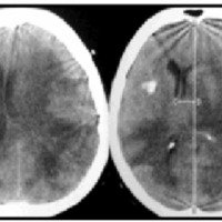 Fig. 6. TAC cerebral a los 10 meses del diagnóstico que evidencia edema cerebral difuso con severo desplazamiento de la línea media.