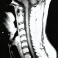 Fig 5: (caso 2) IRM realizada 7 meses luego de la cirugía, observándose colapso del sirinx y ascenso de las amígdalas a posición normal, con reaparición de la cisterna magna.