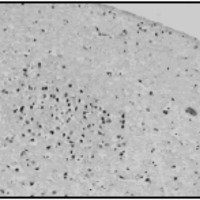 Fig. 3. (H-E x 250) Cerebro. Sustancia gris cortical con pérdida de la laminación horizontal normal por desorganización de las capas neuronales. Trastorno de la Migración Neuronal: Displasia Cortical tipo nodular.