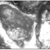 Fig. 3. Fotografía intraoperatoria mostrando mastoidectomia e exposición de la duramadre de la fosa media