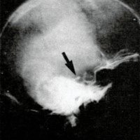 Figura 1d: Radiografía simple de control alejado con balón desinflado.