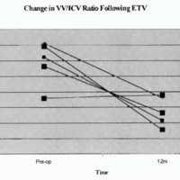 Fig. 2. Graphical illustration of change of W/ICV as a result of ETV (each line represents one patient)<br />
Change in VV/ICV Ratio Following ETV