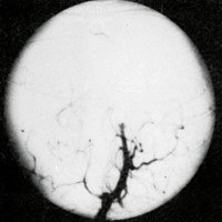 Figuras 1D. Angiografía selectiva de la arteria vertebral izquierda, post-operatoria, en proyecciones de frente (D) y perfil (E), que demuestra la oclusión de la fístula