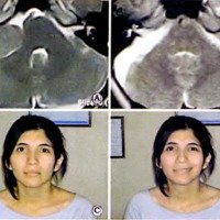 Fig. 8. Caso 16 del Cuadro 1. Paciente mujer de 31 años, con un tumor T4 a. A. IRM preoperatoria. B. IRM postoperatoria. C y D. Función facial postoperatoria.