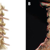 Figura 3: A: Osteotomía grado 2. B: Fotografía 3D de la Osteotomía grado 2.
