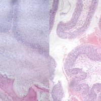 Figura 5: Cortes histológicos de la lesión extraída. A la izquierda, aspecto microscópico de bajo aumento (10X) de lesión papilomatosa con inclusión de tejido óseo. A la derecha, epitelio respiratorio superior con crecimiento endofítico y de aspecto papilar.