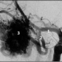 Fig. 4. MAV temporal derecha, alimentada por la cerebral media (1), con una gruesa arteria terminal (2) que arriba al nido (3)