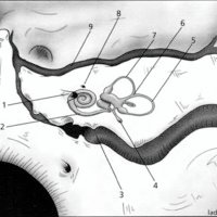 Fig. 4. Visión anatómica de la superficie cerebelosa del peñasco. 1: poro acústico; 2: canalículo codear; 3: bulbo yugular; 4: conducto endolinfático; 5: conducto semicircular posterior; 6: cruz; 7: conducto semicircular superior; 8: fosita subarcuata; 9: seno petroso superior