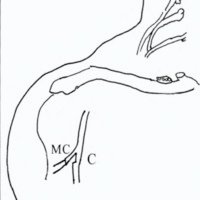 Fig. 3. Neurotización del musculocutáneo con algunos fascículos del cubital (técnica de Oberlin), C: cubital, MC: musculocutáneo.
