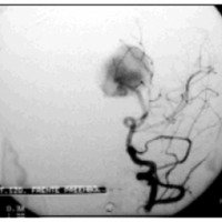 Fig. 4. Angiografía cerebral de la arteria carótida izquierda (frente), que muestra una MAG tipo coroide