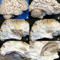Figura 13:  Visión  de la  cara  lateral  del  hemisferio  cerebral derecho  a  través  de  la disección  de fibras  blancas por la  técnica de Klinger. 1) Fibras en  “U”; 2. Valécula; 3) Córtex insular; 4) Alza de Meyer; 5) Estrato sagital; 6) Fascículo uncinado; 7) Putamen; 8) Hipocampo; 9) Núcleo caudado; 10) Fascículo occipitofrontal 11) Plexo coroideo.